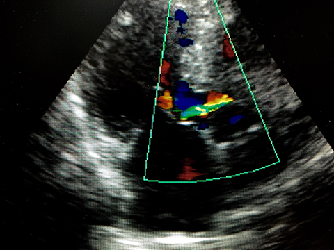 心エコーで描出された大動脈弁逆流